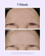 Before and after comparison of a person's face with text '1 Week' above.